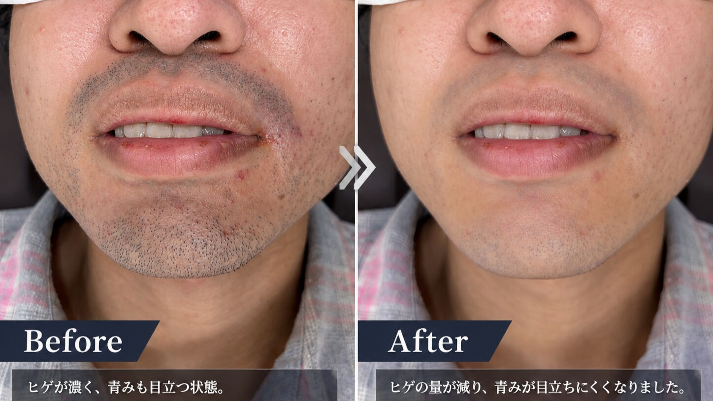 メンズ脱毛、初心者にもおすすめ