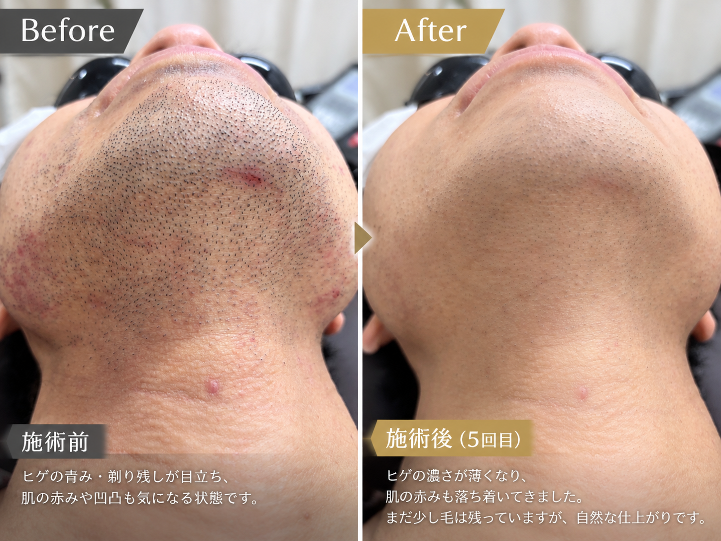 男性の皆さん、ヒゲのお手入れに困っていませんか？