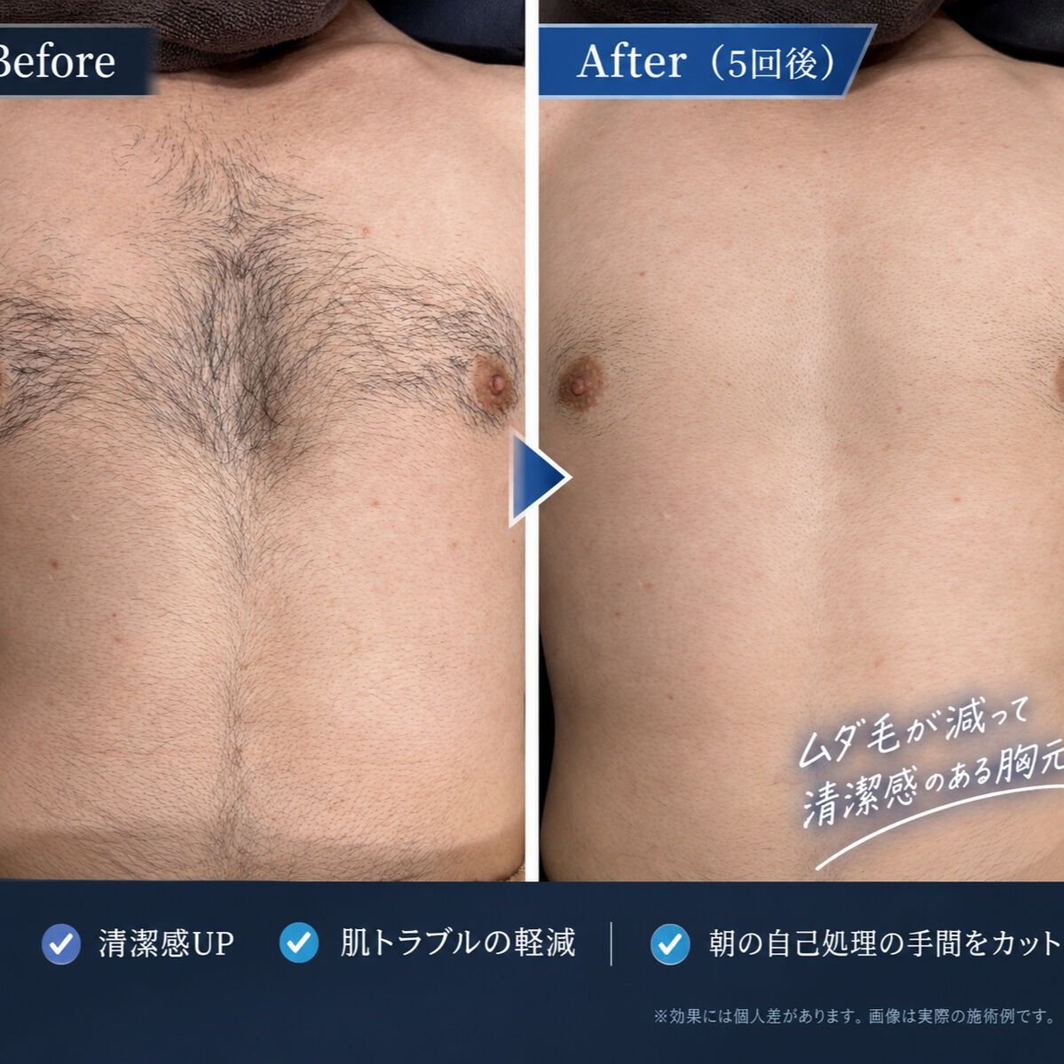 脱毛を考えている男性のみなさんへ