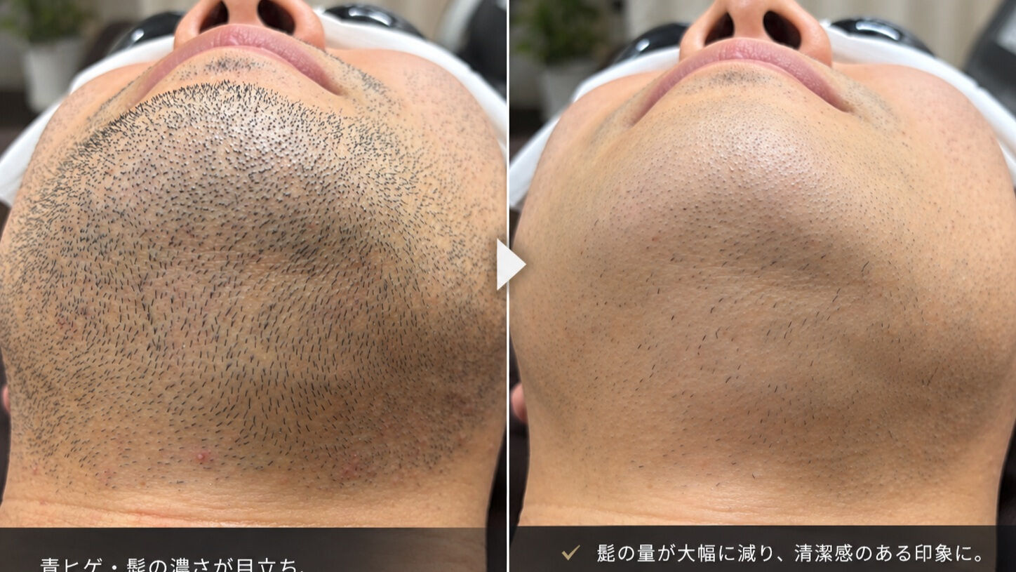髭のケアから解放される日がやってきました