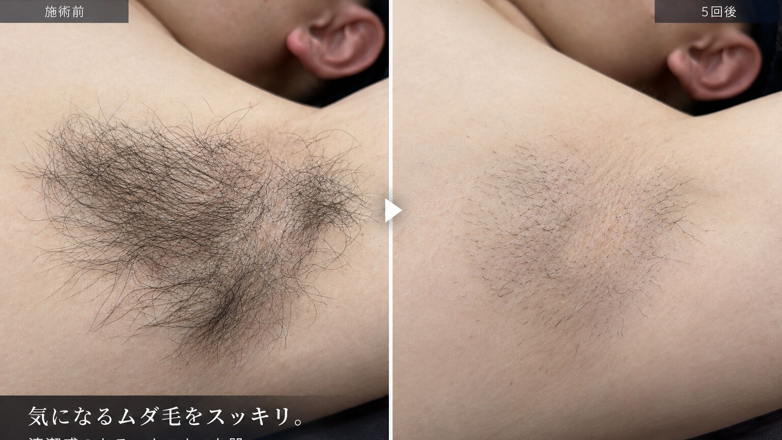 つるつる肌を目指してみませんか